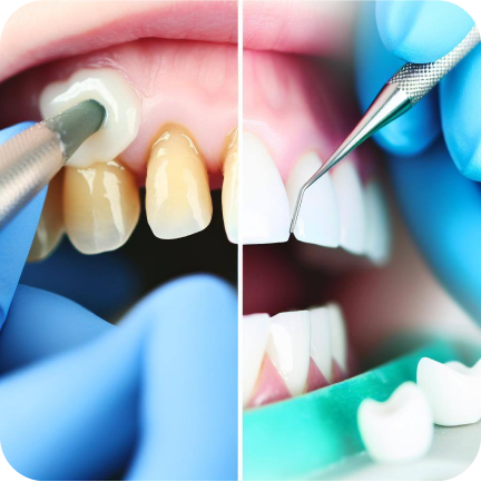 Dental Bonding vs. Veneers: Choosing the Best for Your Smile